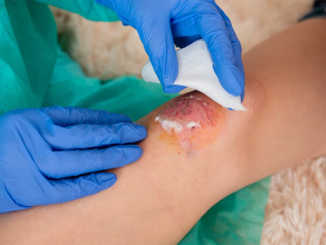 Cleaning a wound with hydrogen peroxide